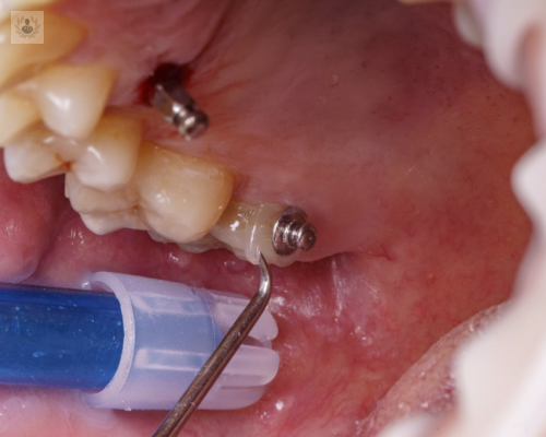 ortodoncia-mediante-microtornillos imagen de artículo