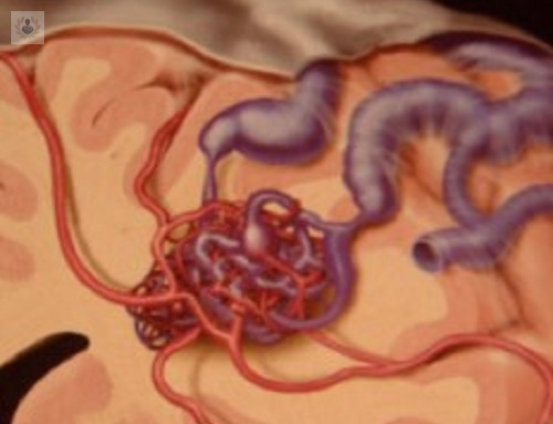 malformaciones-vasculares imagen de artículo