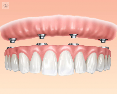 La Carga Inmediata en Implantes Dentales