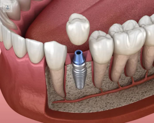 la-efectividad-de-los-implantes-dentales imagen de artículo