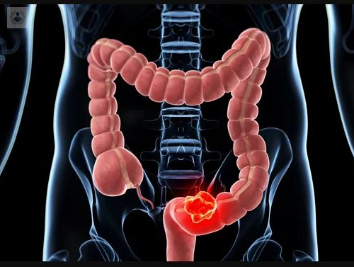cancer-de-colon imagen de artículo