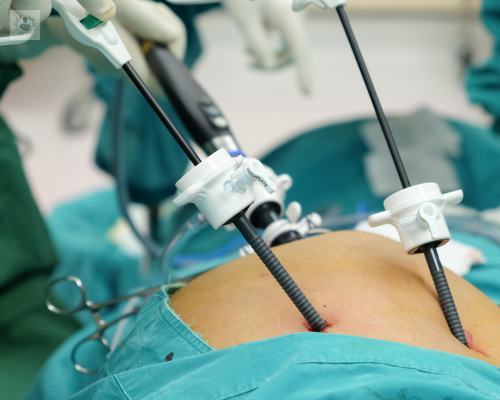 Cirugía de la Vesícula Biliar por Minilaparoscopia
