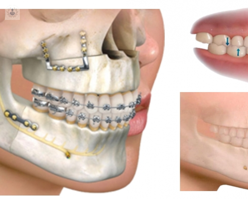 cirugia-ortognatica-un-tratamiento-combinado imagen de artículo