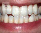 implantes-dentales-oseointegrados imagen de artículo