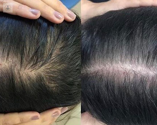 Alopecia Androgenética Femenina