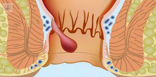 patologia-anal-en-el-paciente-gay imagen de artículo