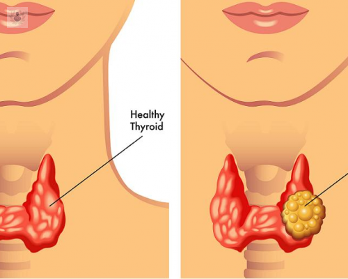nodulo-tiroideo imagen de artículo