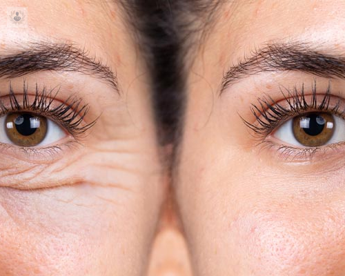 blefaroplastia-inferior-como-acabar-con-las-bolsas-en-los-ojos imagen de artículo