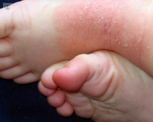 Dermatitis Atópica en niños