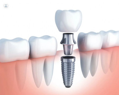 unos-dientes-perfectos-con-implantes-dentales imagen de artículo