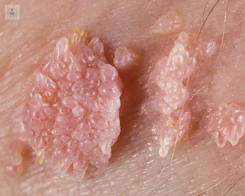 condilomas-acuminados-anales-como-prevenirlos-y-tratarlos imagen de artículo