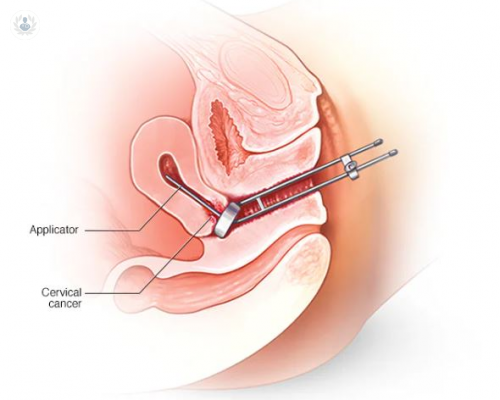 braquiterapia-la-mejor-alternativa-para-el-cancer-de-prostata imagen de artículo