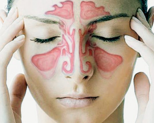 Sinusitis, una enfermedad del sistema respiratorio