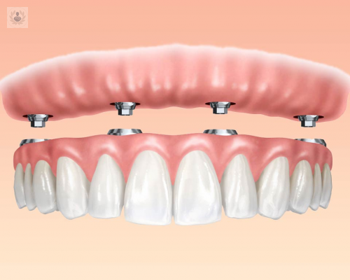 preguntas-frecuentes-sobre-implantes-dentales imagen de artículo