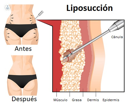 liposuccion imagen de artículo