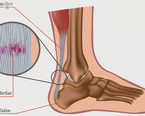 el-tendon-de-aquiles imagen de artículo