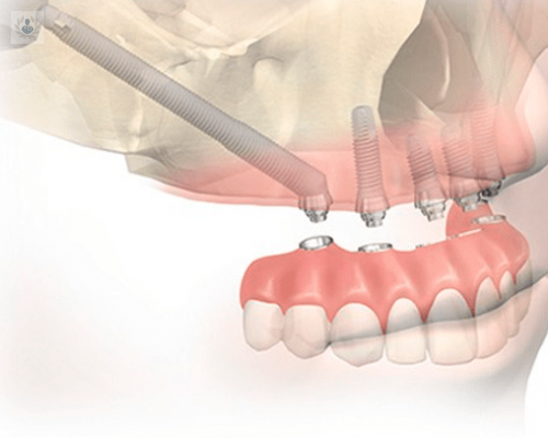 los-implantes-pterigoideos imagen de artículo