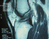 el-ligamento-cruzado-anterior-y-sus-lesiones imagen de artículo