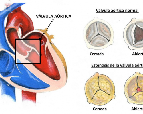 las-nuevas-valvulas-sin-sutura-sutureless-son-la-mejor-solucion-para-el-paciente-de-edad-avanzada-con-problemas-en-la-valvula-aortica imagen de artículo