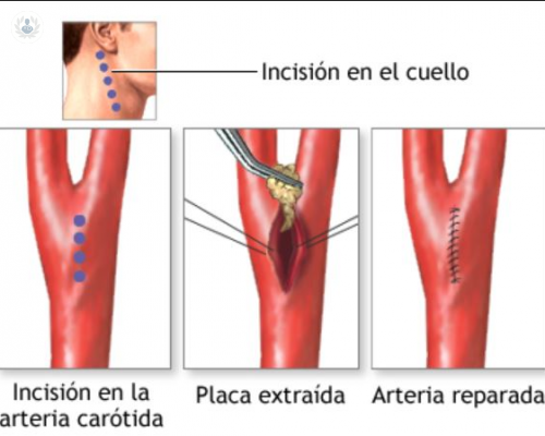 cirugia-de-la-arteria-carotida imagen de artículo