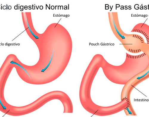 bypass-gastrico-contra-la-obesidad-y-la-diabetes-mellitus-tipo-2 imagen de artículo