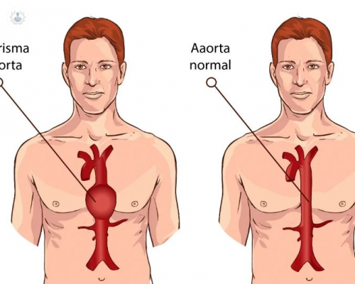 aneurisma-de-aorta imagen de artículo