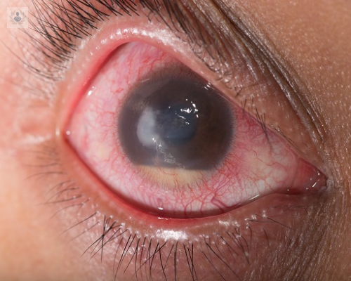 El Glaucoma: la principal causa de Ceguera irreversible