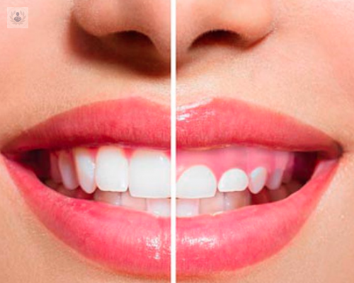 sonrisa-gingival-un-problema-estetico-y-de-salud imagen de artículo