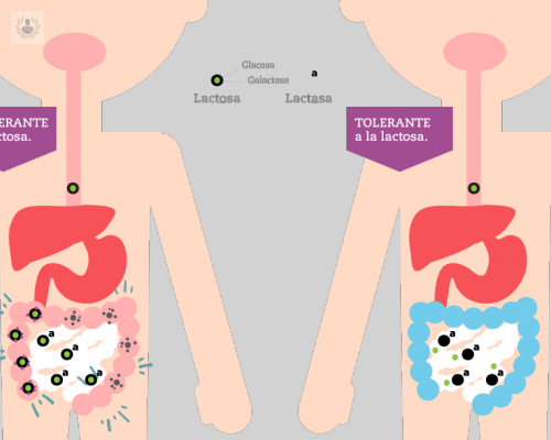 malabsorcion-de-lactosa imagen de artículo