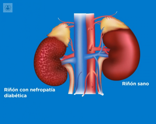 la-enfermedad-renal-diabetica-o-nefropatia-diabetica imagen de artículo