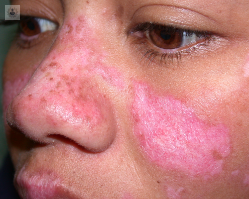 Lupus Eritematoso: una enfermedad que va más allá de la piel