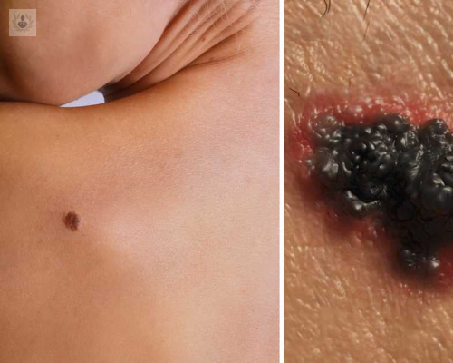 preguntas-habituales-sobre-el-melanoma imagen de artículo