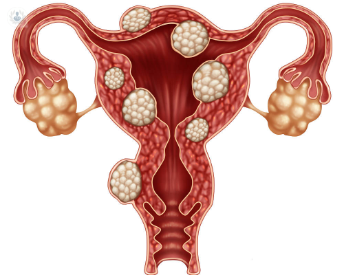 mioma-uterino-un-proceso-benigno imagen de artículo