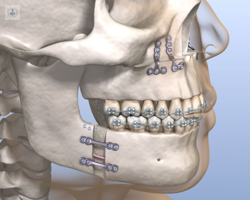 cirugia-ortognatica-una-combinacion-de-ortodoncia-y-cirugia-maxilofacial imagen de artículo