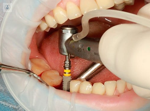 Nuevas técnicas en Implantes Dentales