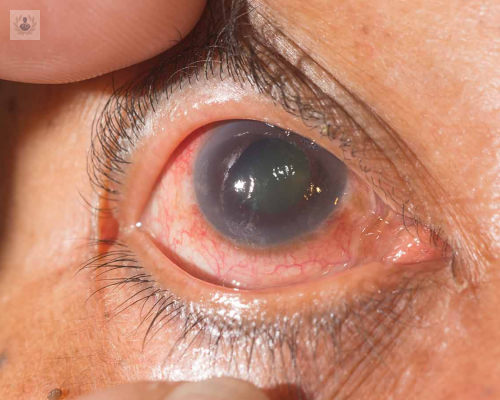 Glaucoma Ocular, tipos y tratamiento