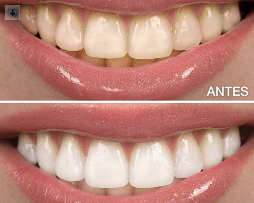 tratamiento-para-conseguir-unos-dientes-blancos imagen de artículo