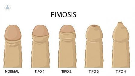 sintomas-y-tratamientos-de-la-fimosis imagen de artículo