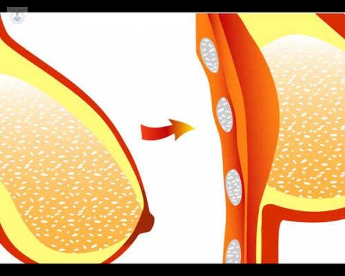 mastopexia-con-protesis imagen de artículo