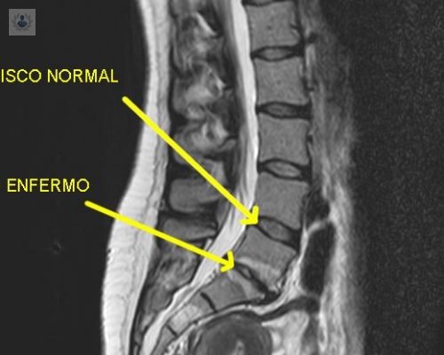 artroplastia-discal-lumbar imagen de artículo