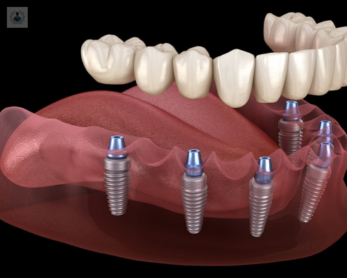 implantes-de-carga-inmediata-una-intervencion-nada-dolorosa imagen de artículo