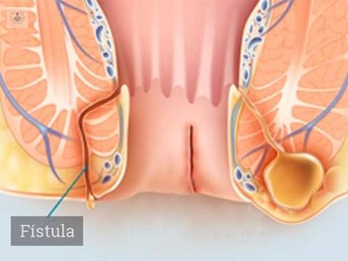 la-fistula-anal-siempre-tratada-en-quirofano imagen de artículo