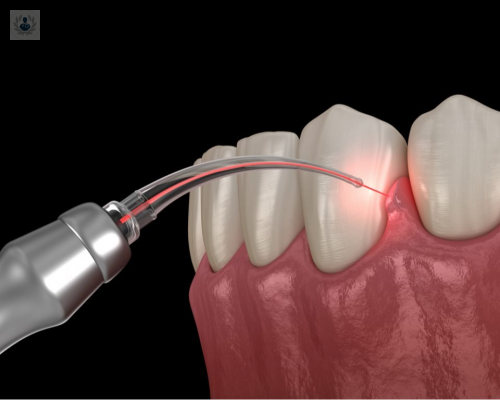 El Láser Dental en Cirugía Odontológica