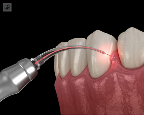 el-laser-dental-en-cirugia-odontologica imagen de artículo