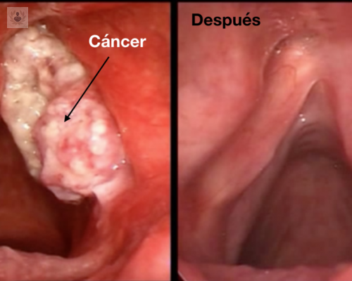 diagnostico-y-tratamiento-del-cancer-de-laringe imagen de artículo