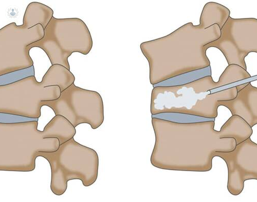 vertebroplastia-el-tratamiento-con-cemento imagen de artículo