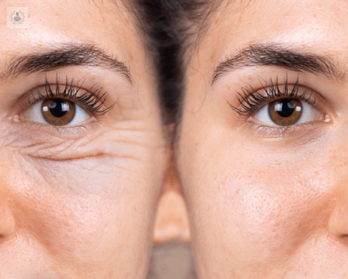 blefaroplastia-consigue-una-mirada-mas-joven imagen de artículo