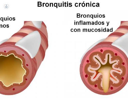 Preguntas frecuentes sobre la Bronquitis Crónica