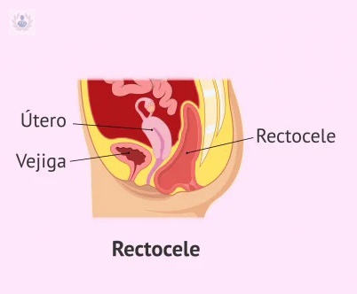 tratamiento-del-prolapso-genital imagen de artículo