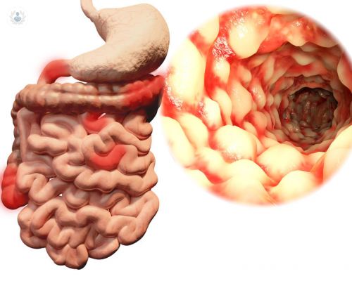 la-enfermedad-de-crohn imagen de artículo